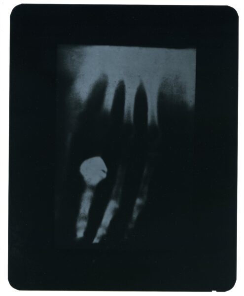 x-ray image of a hand